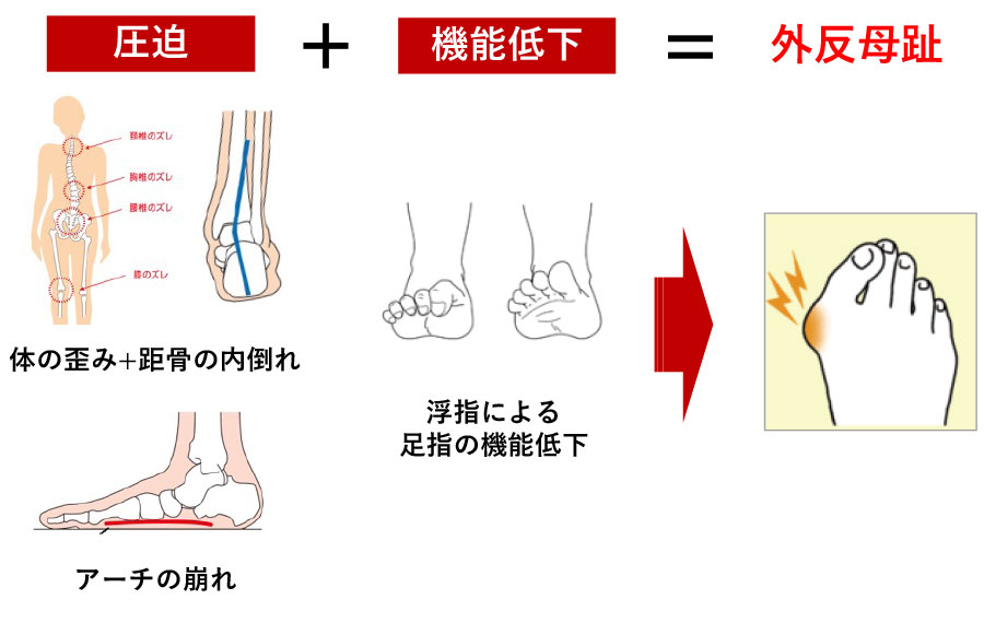 外反母趾の痛みの種類